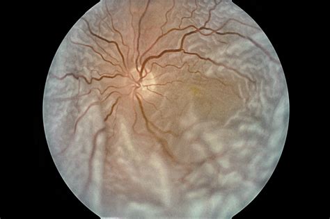 Widefield Oct Shows Effects Of Rhegmatogenous Retinal Detachment Surgery Ophthalmology Advisor