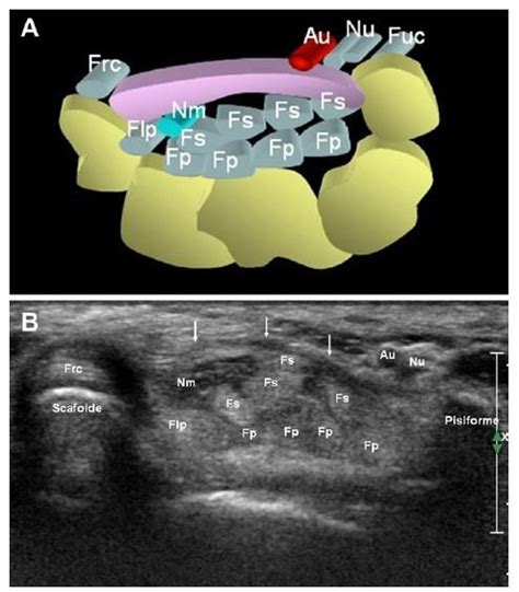 Carpal Tunnel Ultrasound