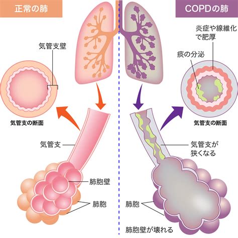 copd copd bqeul