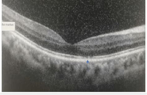 Sd Oct Macula Of The Right Eye Show Resolution Of Subretinal Fluid