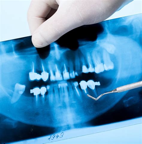 Panoramic Dental X Ray Technique Vinmec