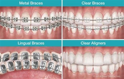 Self Ligating Braces Vs Traditional Braces Shuptrinedebra