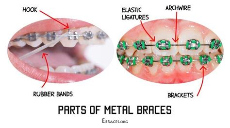 Everything You Need To Know About Rubber Bands For Braces