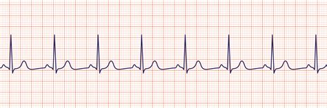 Ekg Rhythm Strips