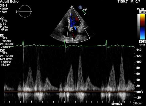 Pulmonary Vein Doppler Flow In A Patient With Fatigue And Dyspnoea Heart