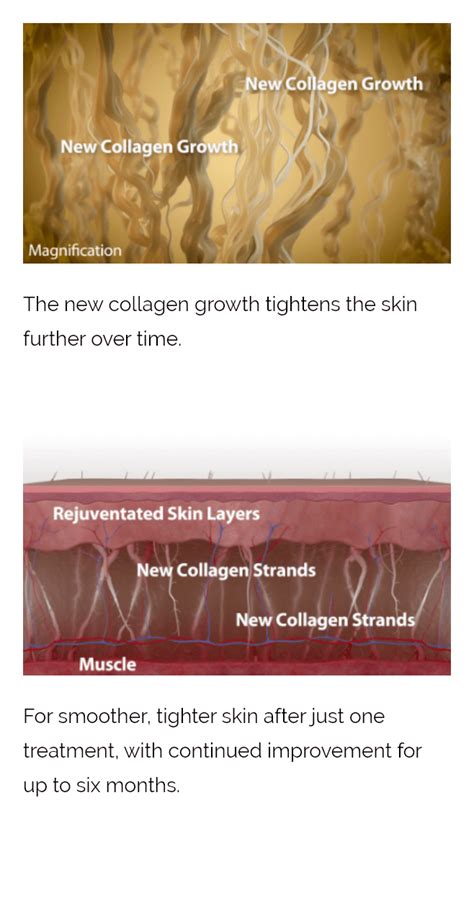 thermage myclinic aesthetic clinic malaysia