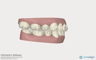 Your Markham Orthodontist Toronto Invisalign And Richmond Hill Braces