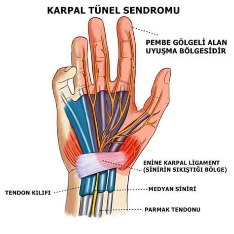 Carpal Tunnel Syndrome Symptoms Assoc Prof Ata Can