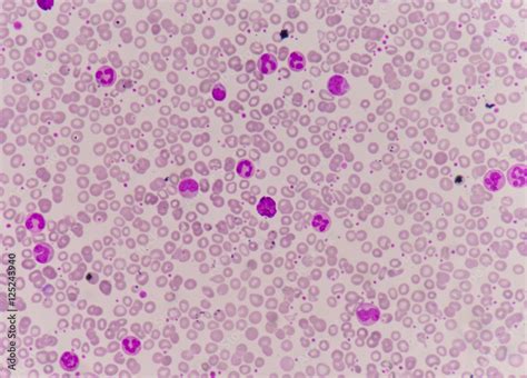 Moderate White Blood Cells Mature Neutrophil And Band Form Neut Foto De