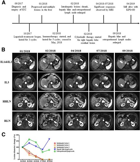 Local And Abscopal Responses In Advanced Intrahepatic