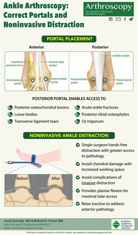 Ankle Arthroscopy Correct Portals And Noninvasive Distraction