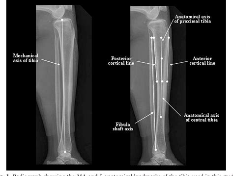 Figure 1 From Anatomical References To Assess The Posterior Tibial