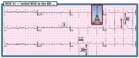 Dr Smith S Ecg Blog Patient With Dyspnea You Are Handed A Triage Ecg