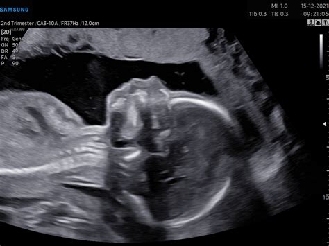 21 Week Ultrasound Profile