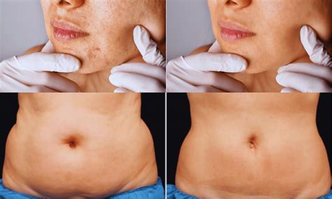 Coolsculpting Before And After Unveil Your Beauty