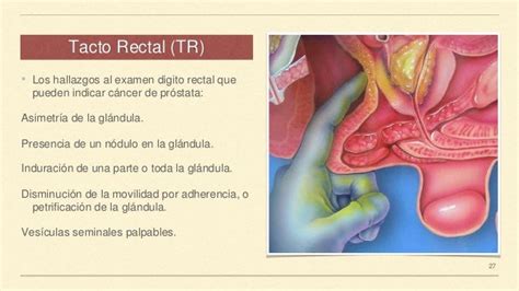 Cancer De Prostata