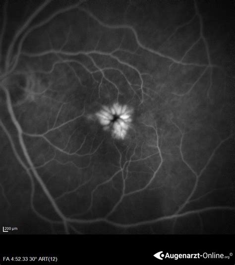 Cystoides Makulaödem CME Atlas der Augenheilkunde