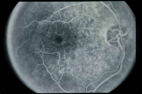 Cone - Rod Dystrophy - Retina Image Bank