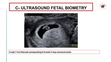 How To Calculate Gestational Age Ppt