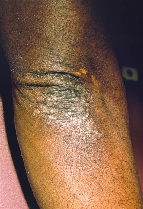 Image:Secondary Syphilis (Elbow)-Merck Manual Professional Edition