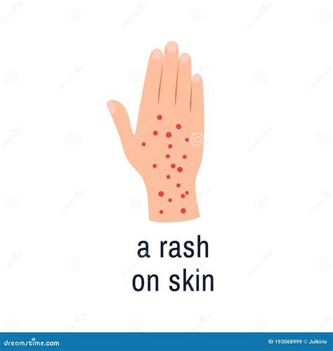 Skin Rash Hives Or Urticaria Vector Illustration 113075188