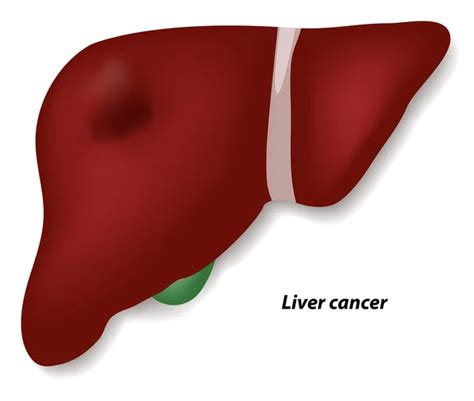 100000 Liver Cancer Vector Images Depositphotos