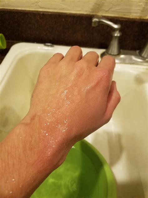 Grease Burn Healing Process Album On Imgur