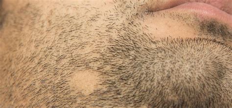 Alopecia areata - symptoms, treatment - Dr Piotr Turkowski