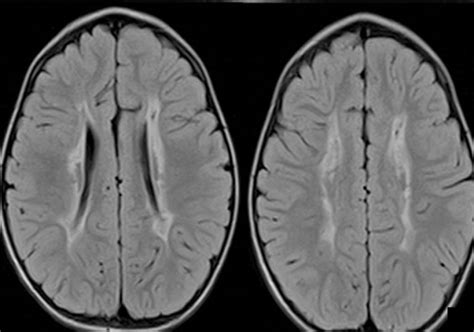 Bilateral Periventricular Leukomalacia PVL Radiology Cases