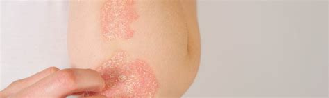 Psoriasis Symptoms Diagnosis And Treatment 24 7medcare