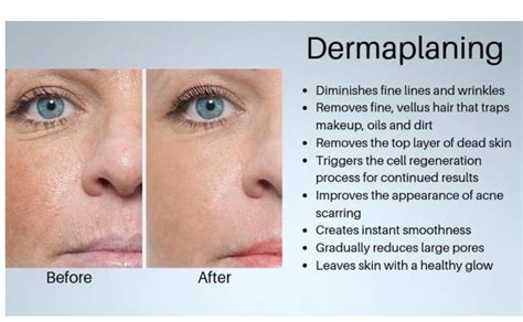 Dermaplaning - Acne, Scars & Facial Spots - SkinWonder Medi Spa ...