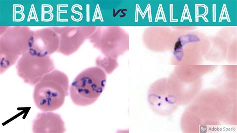 Babesiosis Vs Malaria Babesia Microti Vs Plasmodium Falciparum And Vivax Microbiology