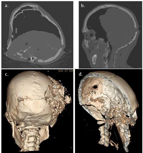 Figure From Post Mortem Computed Tomography Pmct Techniques In