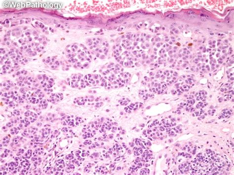 Melanoma Vertical Growth Phase