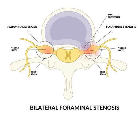 Bilateral Foraminal Stenosis | Bonati Spine Institute
