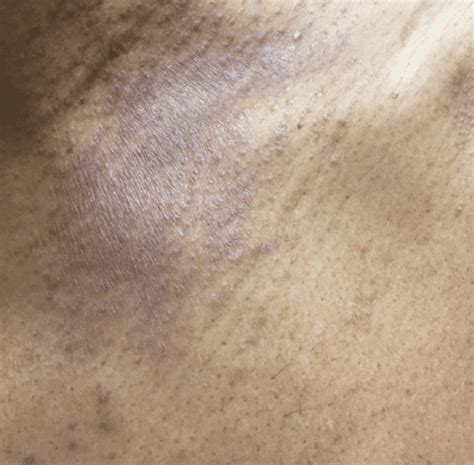 What Does Eczema Look Like on Black People's Skin?