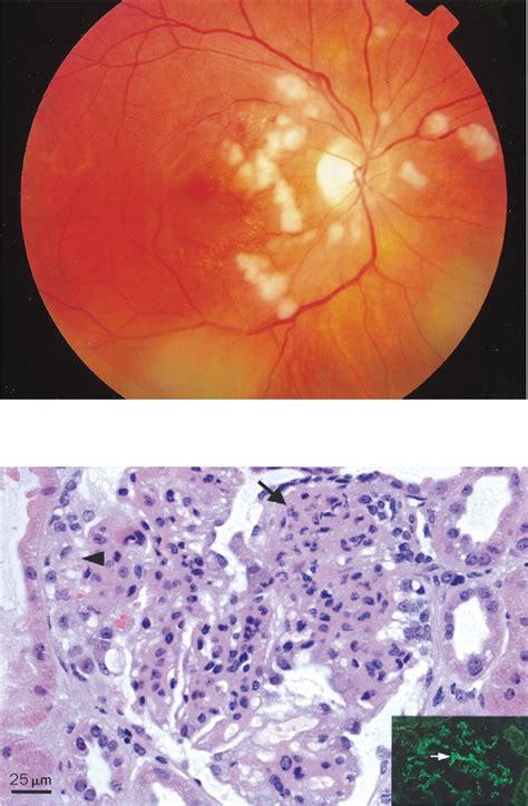 Hypertensive Retinopathy The Lancet