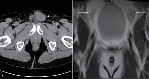 Testicular Lesions Radiology Key