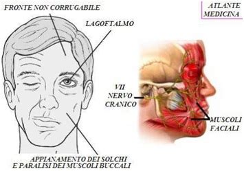 Paralisi Otogena Del Nervo Facciale Otorino Tanzariello