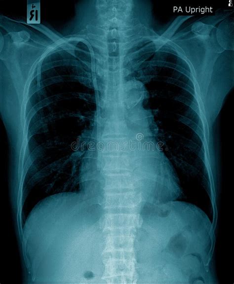 Image De Radiographie Pulmonaire Dans Le Ton Bleu Photo Stock Image