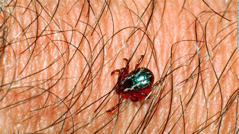 Rocky Mountain spotted fever: the deadliest tick-borne disease - CNN