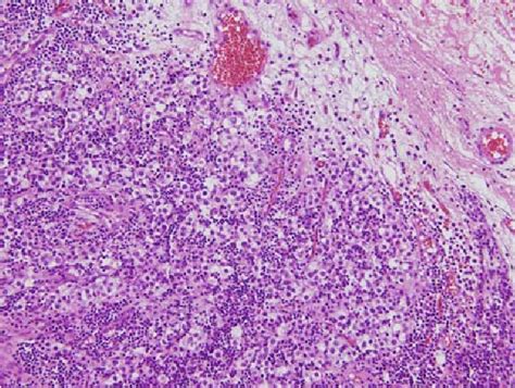 Figure 4 From A Case Of Mixed Germ Cell Tumor Of The Mediastinum