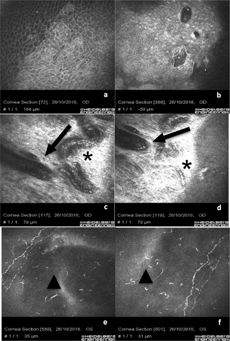 Combined Xen Gel Stent Plus Phacoemulsification A B Show The