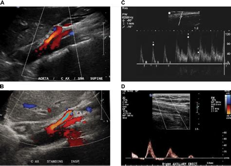 Pulse wave Doppler ultrasound in vascular compression syndrome. Notes ...