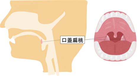 扁桃腺の場所を図と画像で解説！手術が必要となるのはどんな場合？