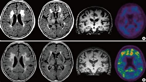 Representative Imaging Scans Of Patients With Pure Subcortical Ischemic Download Scientific