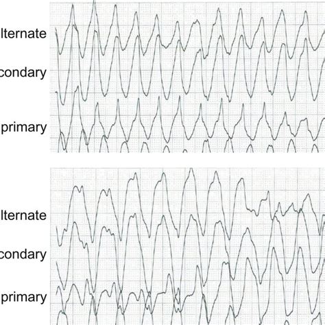 Ventricular Tachycardia During Screening For Subcutaneous Implantable Download Scientific