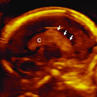 Parasagittal View Of The Fetal Brain In Case Showing Echogenic