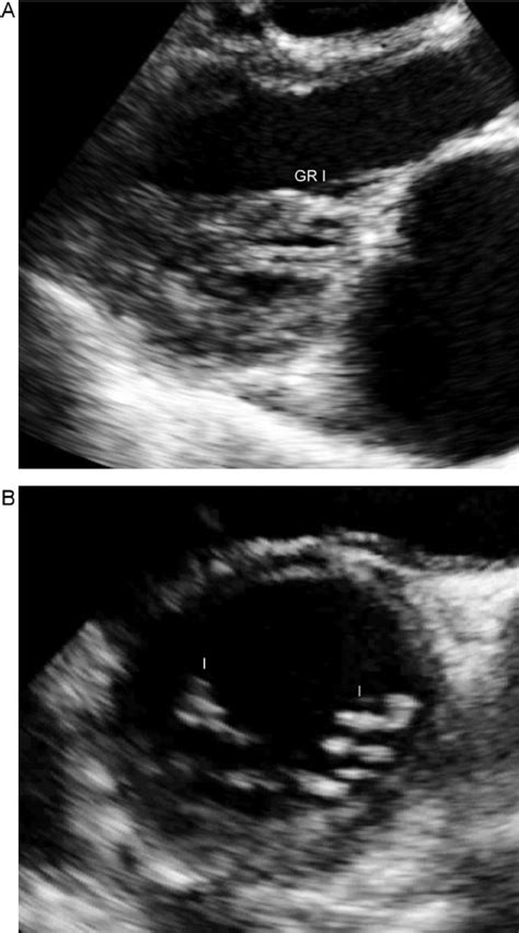 Parasternal Long Axis Plax A And Short Axis Sax B View