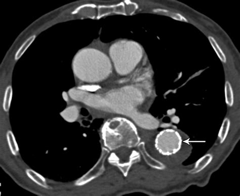 Thoracic Aortic Stent Grafts Utility Of Multidetector CT For Pre And